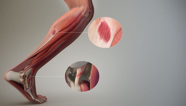 Sprain_SAG
