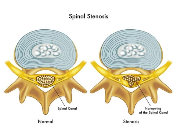 sciatica cause