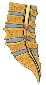 sciatica cause