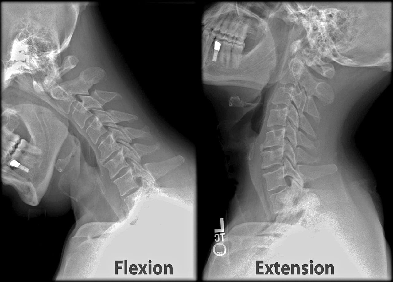 whiplash injuries explained