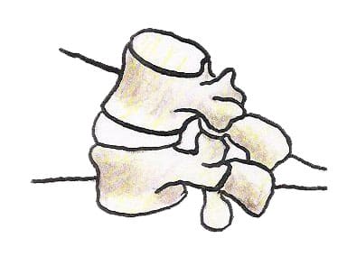 whiplash injuries explained