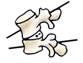 whiplash injuries explained