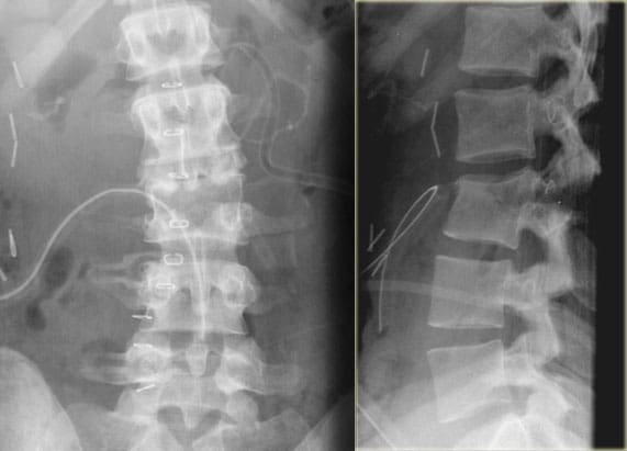 Spine Trauma Imaging Diagnostics Evaluation | El Paso, TX Chiropractor