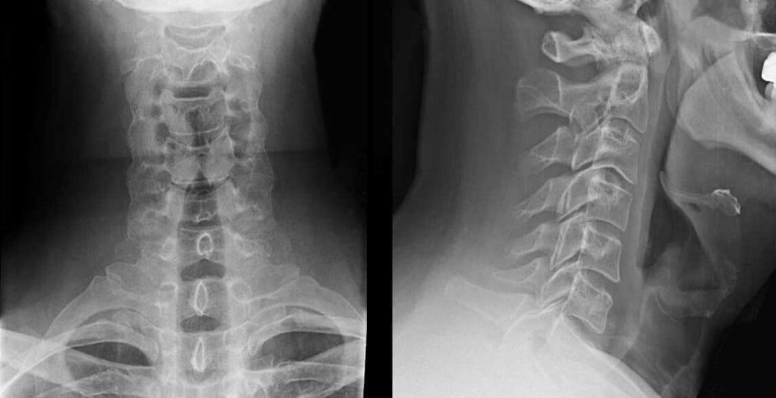 Cervical Spine Radiographs in the Trauma Patient | El Paso, TX Chiropractor