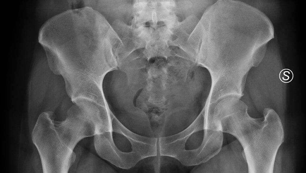 Osteitis Pubis Treatment | El Paso, TX Chiropractor
