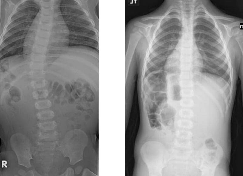 Scoliosis Clinical Presentation | El Paso, TX Chiropractor