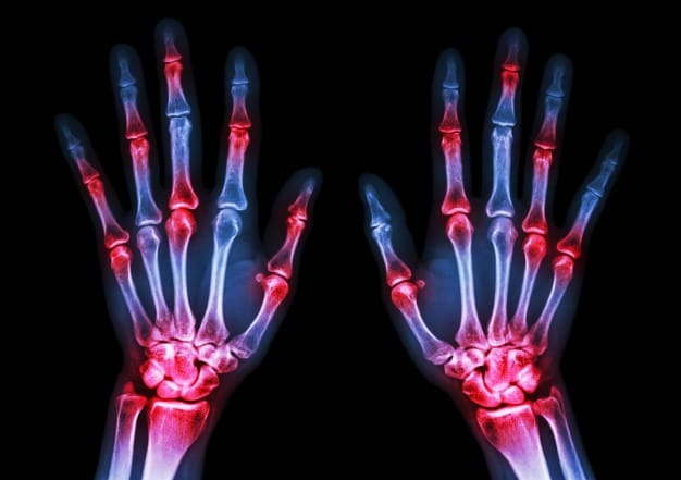 Diagnosis and Management of Rheumatoid Arthritis | El Paso, TX Chiropractor