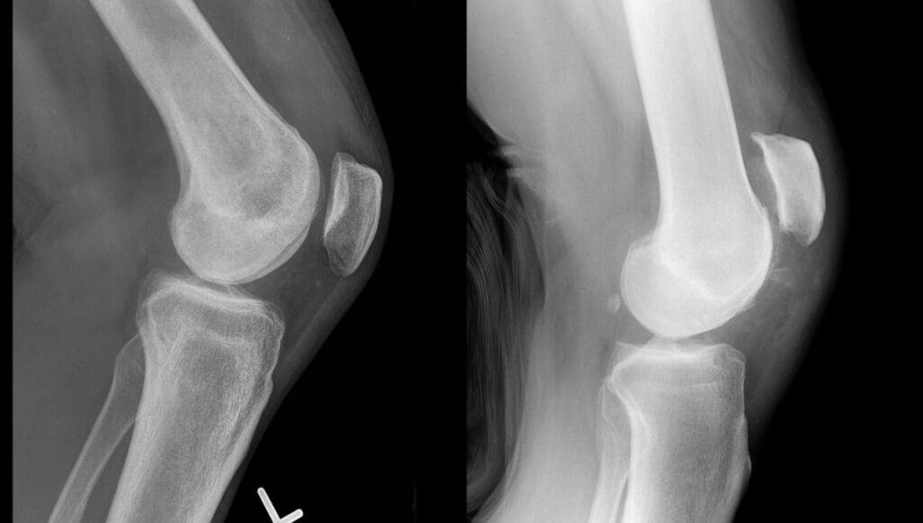 What is a Quadriceps Tendon Rupture? | El Paso, TX Chiropractor